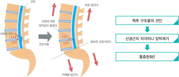견인치료